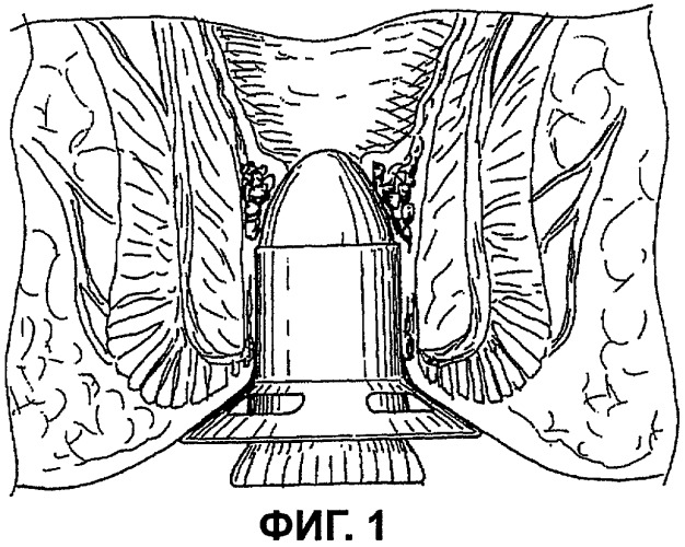 Хирургическое устройство для чрезанального доступа к прямой кишке пациента (патент 2445020)