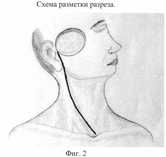 Способ хирургического лечения распространенного рака кожи околоушной области с метастазами в лимфатические узлы шеи (патент 2445005)