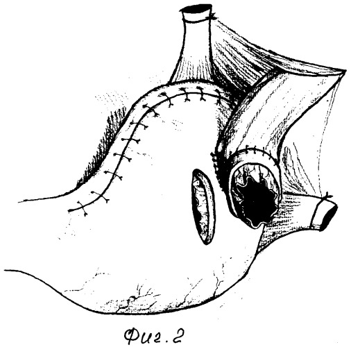 Способ формирования арефлюксного эзофаго-гастроанастомоза при лечении рака желудка (патент 2346661)