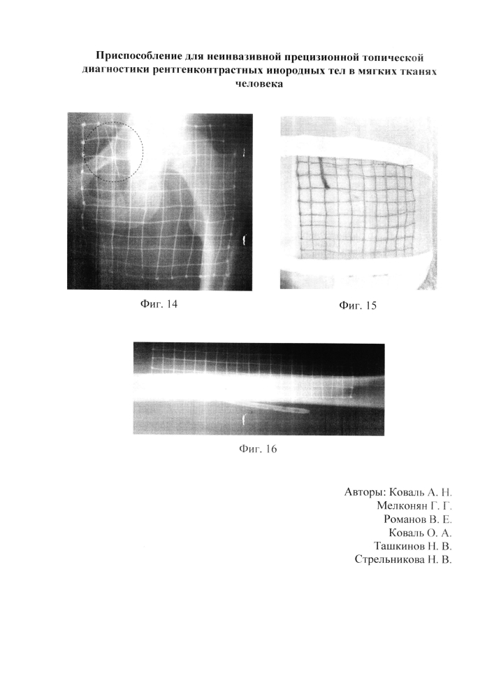 Приспособление для неинвазивной прецизионной топической диагностики рентгенконтрастных инородных тел в мягких тканях человека (патент 2602457)