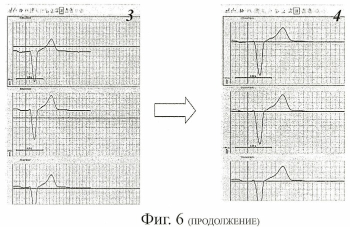 Способ неинвазивного электрофизиологического исследования сердца (патент 2435518)