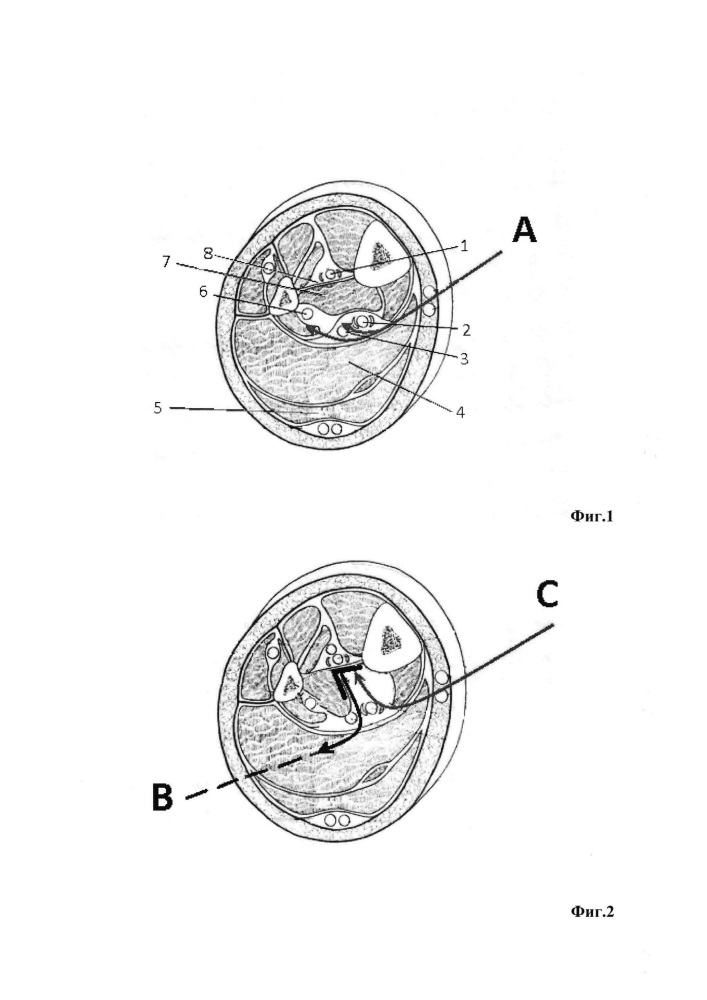 Способ оперативного доступа для выделения и шунтирования передней большеберцовой артерии (патент 2611933)
