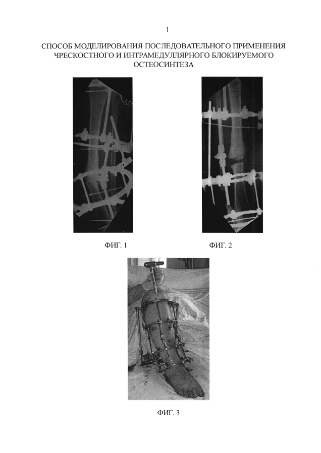 Способ моделирования последовательного применения чрескостного и интрамедуллярного блокируемого остеосинтеза (патент 2593583)