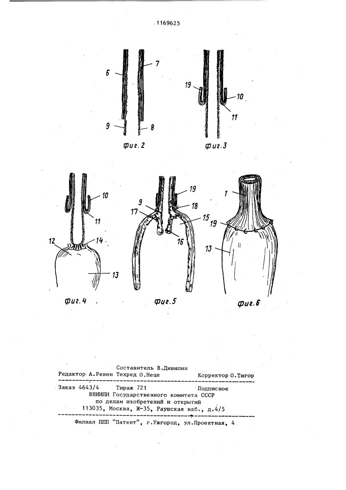 Способ формирования пищеводно-желудочного анастомоза (патент 1169625)