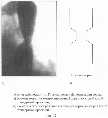 Способ диагностики изолированной коарктации аорты и способ выбора тактики ее лечения (патент 2244510)