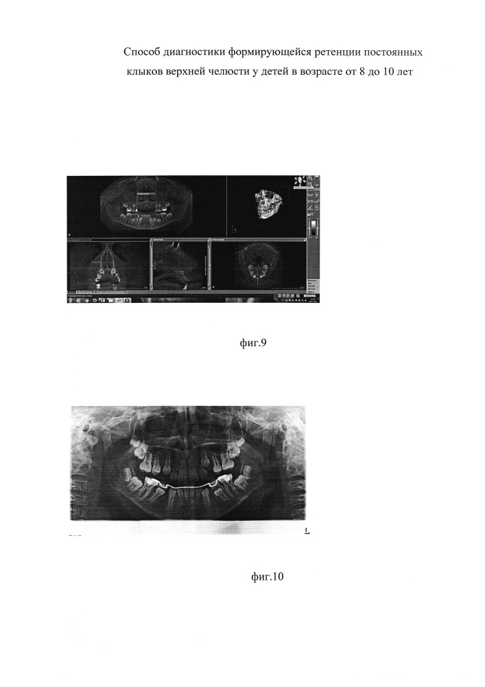 Способ диагностики формирующейся ретенции постоянных клыков верхней челюсти у детей в возрасте от 8 до 10 лет (патент 2629329)