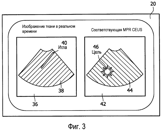 Интервенционная навигация с использованием трехмерного ультразвука с контрастным усилением (патент 2494676)