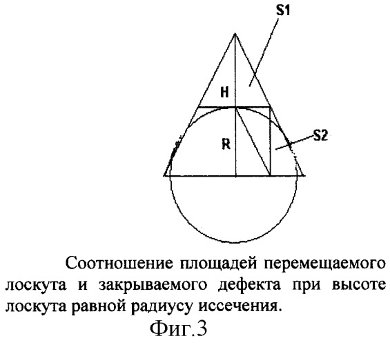 Способ сочетанного закрытия дефекта кожи местными тканями и свободными кожными лоскутами (патент 2326609)