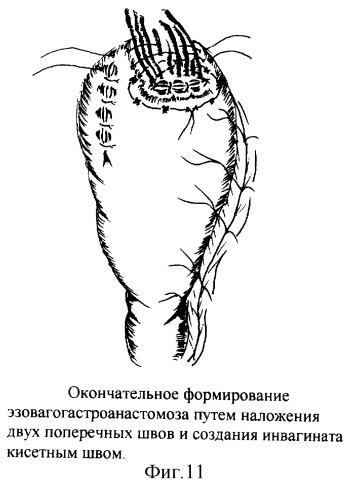 Новый способ формирования эзофагогастроанастомоза в условиях недостатка пластического материала путем модификации задней губы (патент 2248185)