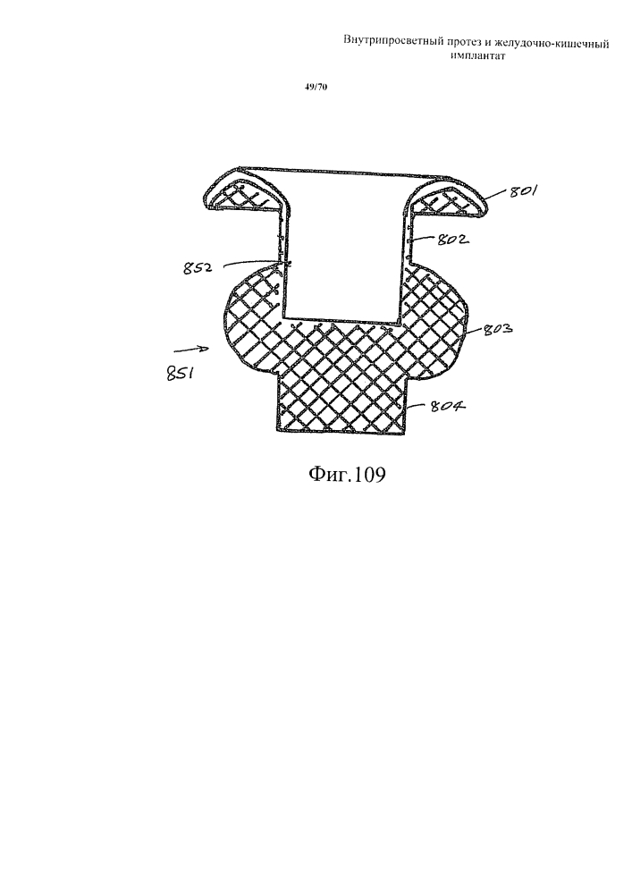 Внутрипросветный протез и желудочно-кишечный имплантат (патент 2626885)