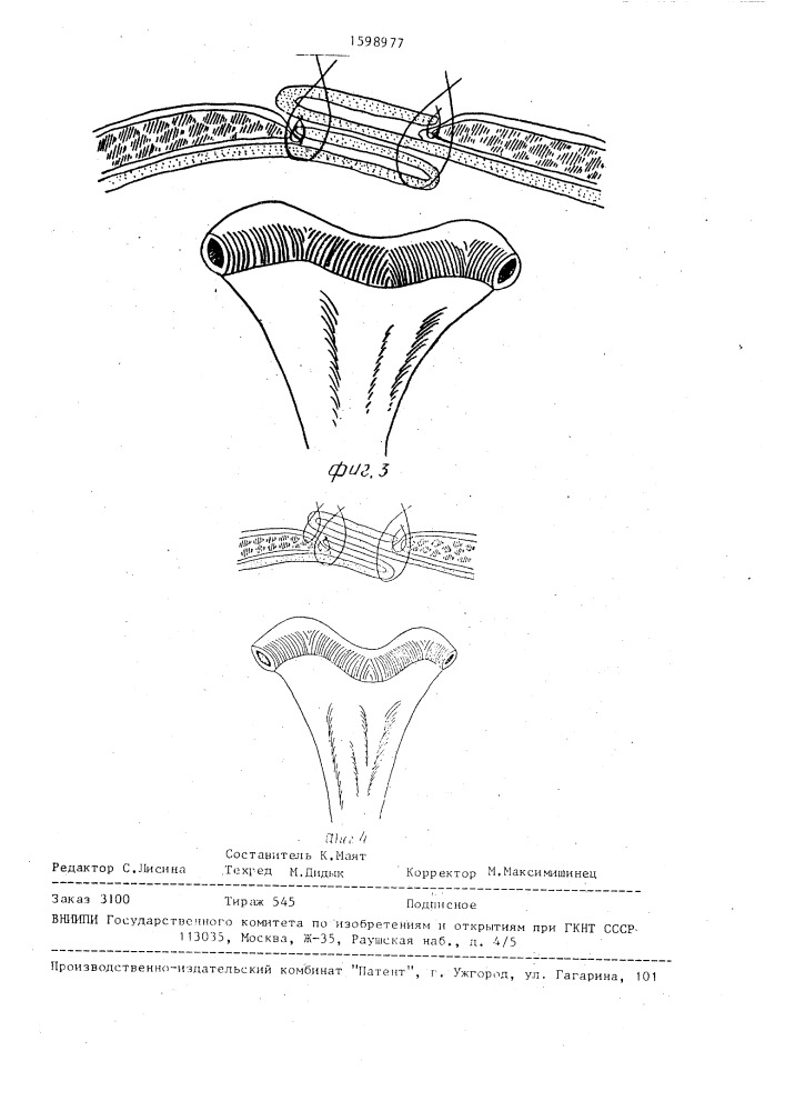 Способ лечения гигантских вентральных грыж (патент 1598977)
