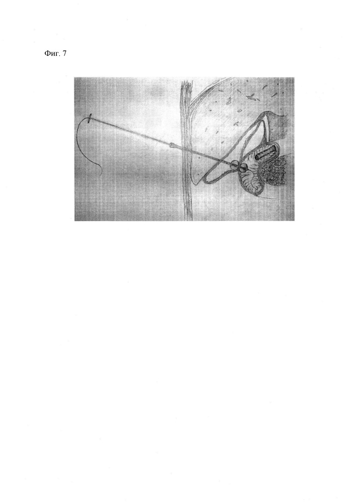 Способ наложения пункционного компрессионного холецистодуоденоанастомоза (патент 2648336)