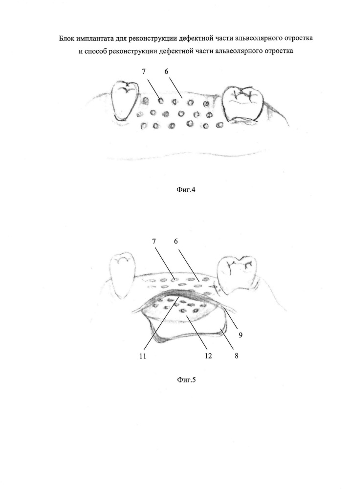 Блок имплантата для реконструкции дефектной части альвеолярного отростка и способ реконструкции дефектной части альвеолярного отростка (патент 2612826)