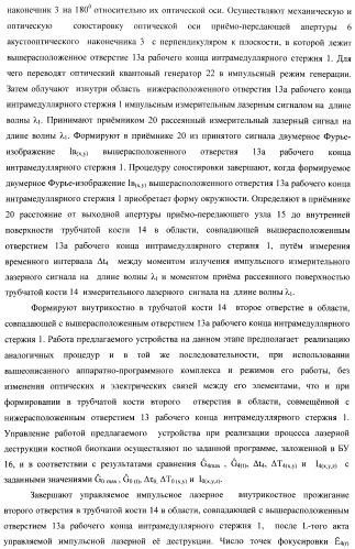 Способ дистального блокирования интрамедуллярных стержней при остеосинтезе длинных трубчатых костей и устройство для его осуществления (патент 2387401)