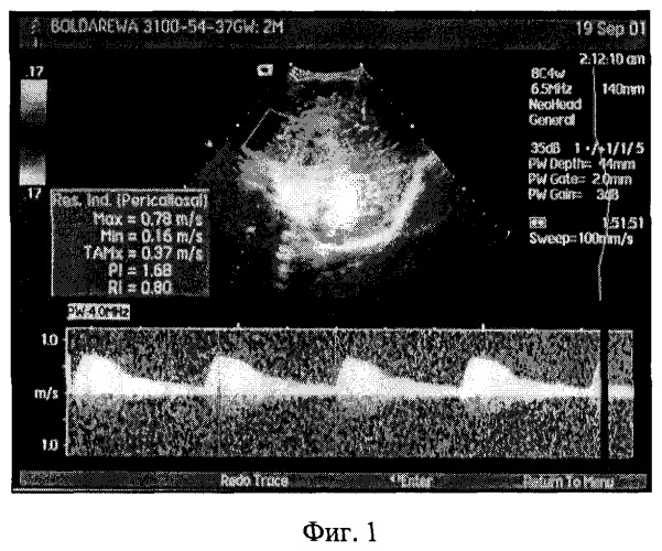 Способ оценки внутримозгового артериального кровотока в восстановительном периоде у детей с перинатальной энцефалопатией (патент 2252705)