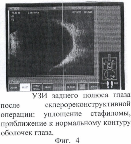 Способ склерореконструктивного лечения высокой близорукости (патент 2367394)