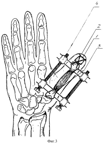 Способ дистракционного удлинения пястной кости при наличии ее культи или короткой культи основной фаланги (патент 2260394)