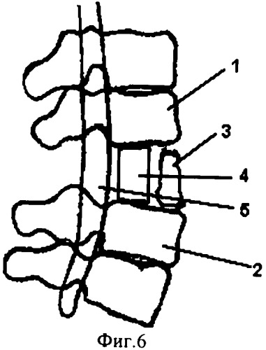 Способ хирургического лечения последствий переломов позвоночника (патент 2279859)