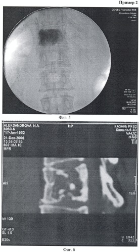 Способ перкутанной вертебропластики при травмах и заболеваниях позвоночника (патент 2432137)