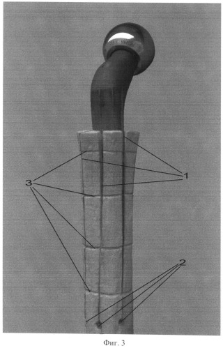 Способ остеотомии проксимального конца бедренной кости для установки и фиксации бедренного компонента эндопротеза тазобедренного сустава при врожденном высоком вывихе бедра (патент 2502487)