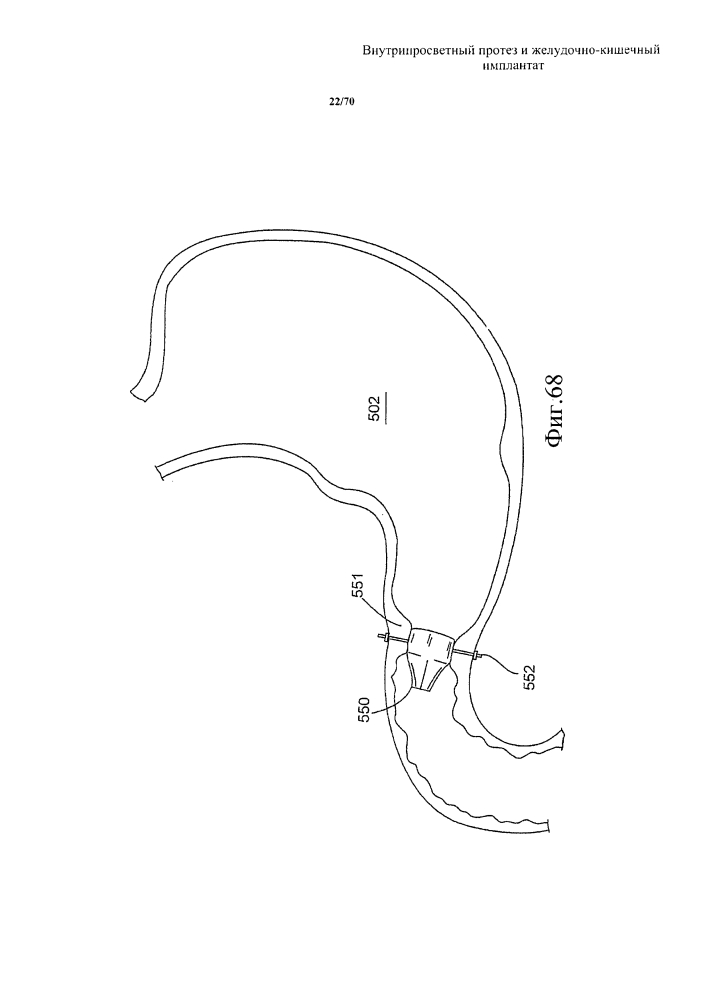 Внутрипросветный протез и желудочно-кишечный имплантат (патент 2626885)