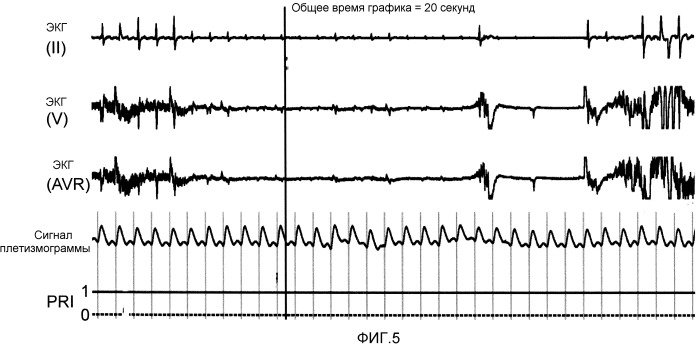 Контроль экг с пониженными ложными тревогами в связи с асистолией (патент 2538623)