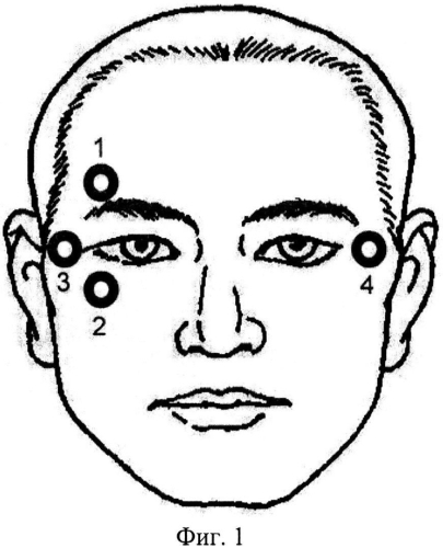 Способ удаления глазо-двигательных артефактов на электроэнцефаллограммах (патент 2560388)