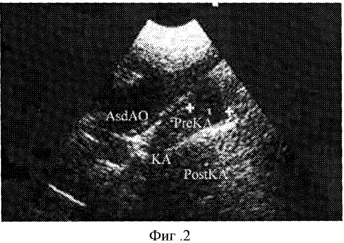 Способ ультразвуковой диагностики коарктации аорты (патент 2244512)