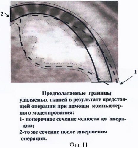 Способ функциональной реабилитации больных, перенесших операции по поводу местнораспространенных опухолей дна полости рта и нижней челюсти (патент 2371141)