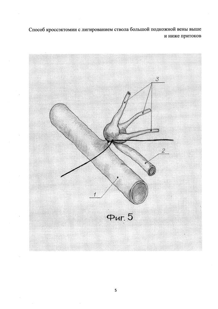 Способ кроссэктомии с лигированием ствола большой подкожной вены выше и ниже притоков (патент 2607919)