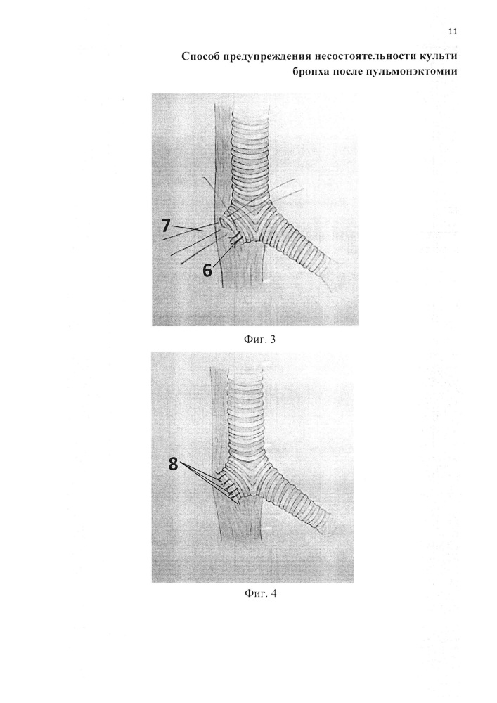 Способ предупреждения несостоятельности культи бронха после пульмонэктомии (патент 2617882)