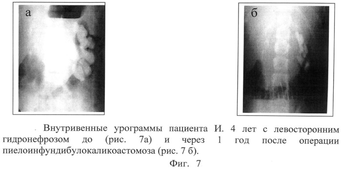 Способ лечения гидронефроза у детей (патент 2495630)