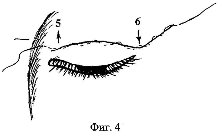 Способ верхней блефаропластики (патент 2289368)