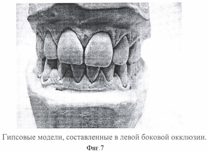 Способ воспроизведения зарегистрированных окклюзионных положений на компьютерных трехмерных моделях зубных рядов и ориентации компьютерных трехмерных моделей в пространстве (патент 2401083)