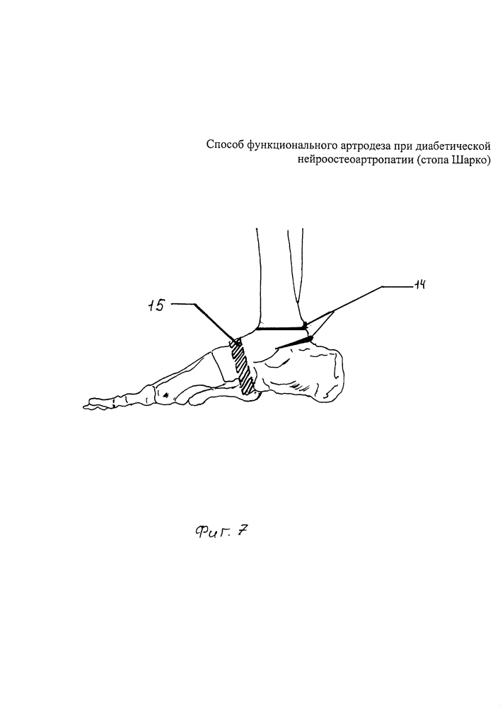 Способ функционального артродеза при диабетической нейроостеоартропатии (стопа шарко) (патент 2604383)