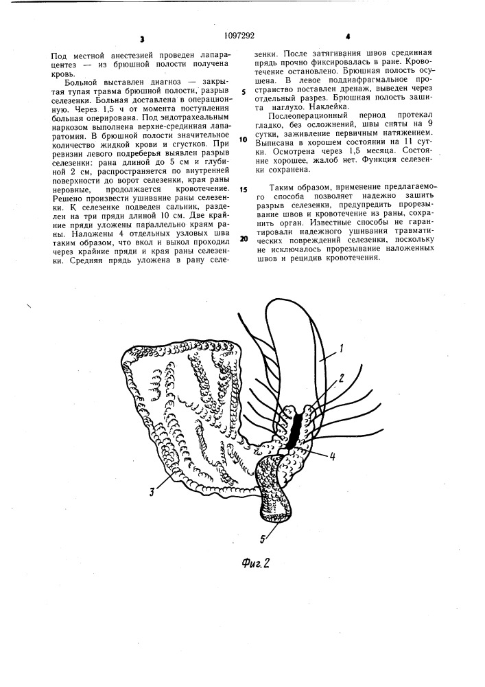 Способ лечения разрывов селезенки (патент 1097292)