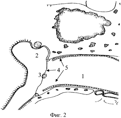 Способ устранения латерализации тимпанальной мембраны (патент 2356521)