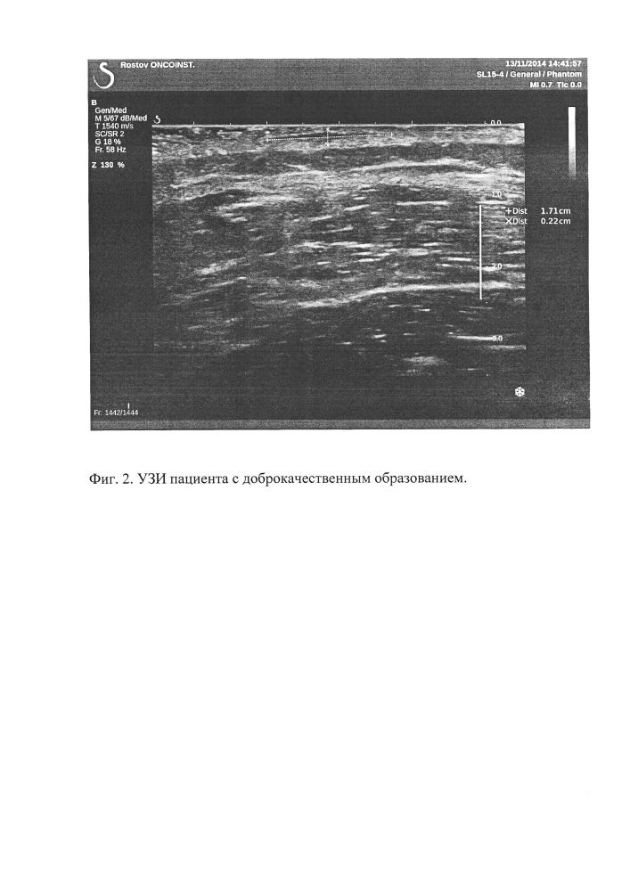 Способ дифференциальной диагностики меланоцитарных образований кожи (патент 2635772)