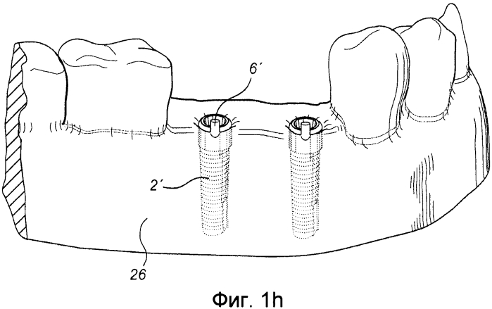Способ обеспечения индивидуальной для пациента конструкции, сопрягающейся с зубным фиксатором (патент 2575144)