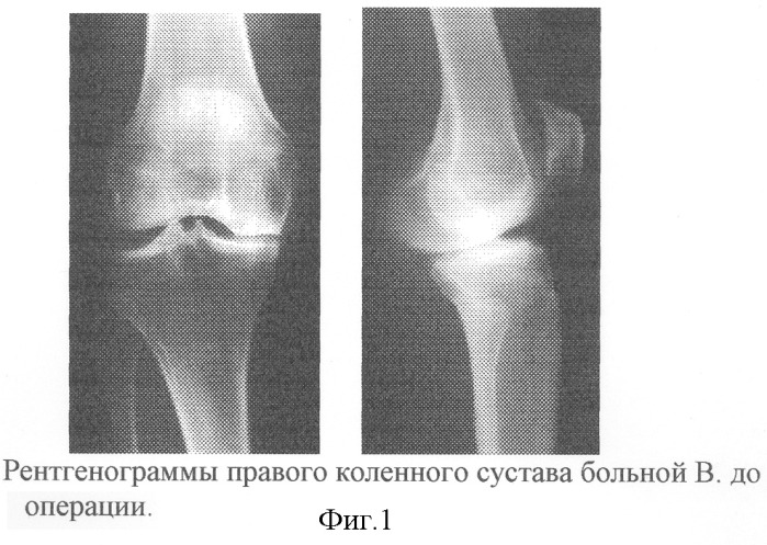 Способ лечения изолированного дегенеративно- дистрофического поражения внутреннего отдела коленного сустава (патент 2246912)