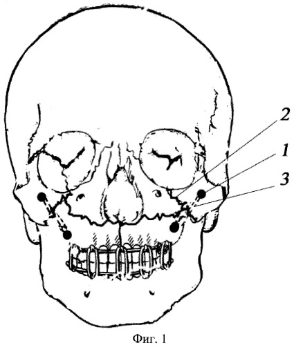 Перелом лицевого черепа. Остеосинтез верхней челюсти. Остеосинтез верхней челюсти костными проволочными швами.. Шов кости при переломе верхней челюсти. Остеосинтез верхней челюсти спицей Киршнера.