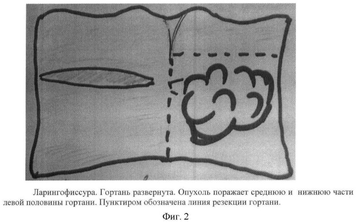 Способ реконструктивной операции на гортани (патент 2463967)