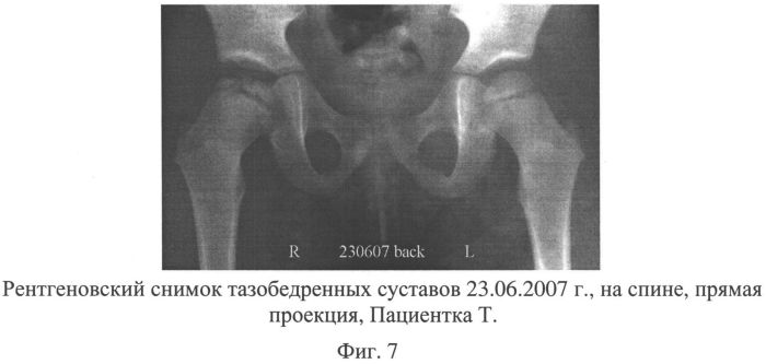 Способ лечения асептического некроза головки бедренной кости и сборы лекарственных растений для осуществления лечения (патент 2558476)