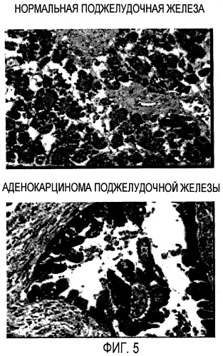 Семейство генов (lbfl313), ассоциированных с злокачественным ростом поджелудочной железы (патент 2432399)