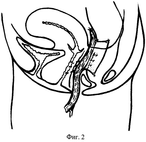 Способ хирургического лечения ректоцеле (патент 2251985)