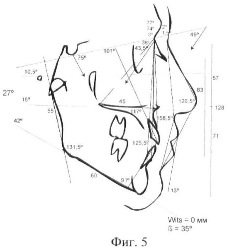 Способ объективной оценки результатов ортодонтического лечения (патент 2444292)
