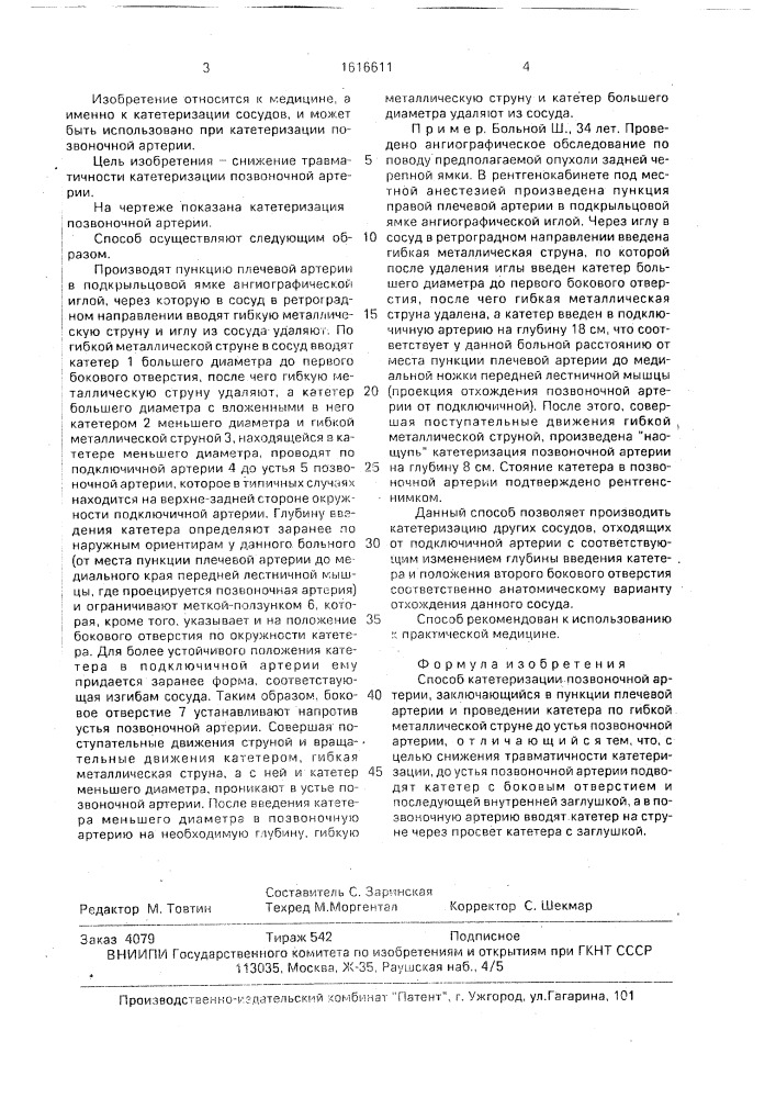 Способ а.в.никонова катетеризации позвоночной артерии (патент 1616611)