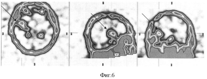 Способ проведения однофотонной эмиссионной компьютерной томографии головного мозга в диагностике и определении степени злокачественности глиальных опухолей (патент 2375961)