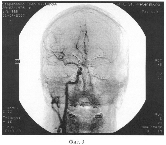 Способ церебральной ангиографии (патент 2348359)