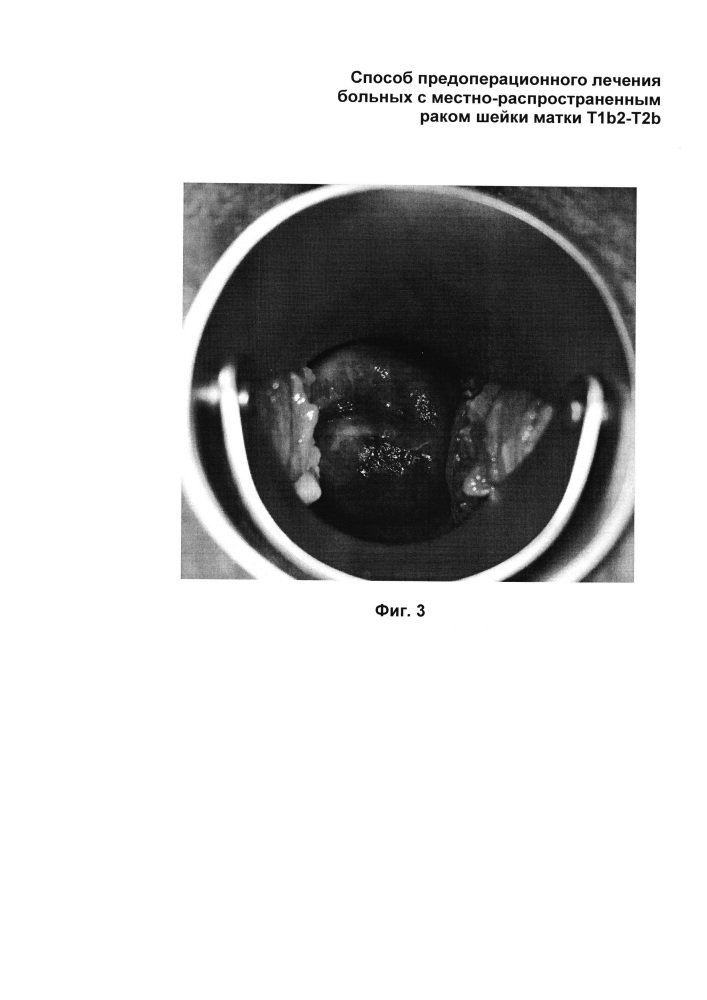 Способ предоперационного лечения больных с местно-распространенным раком шейки матки t1b2-t2b стадии (патент 2613888)